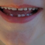 preschooler-losing-tooth