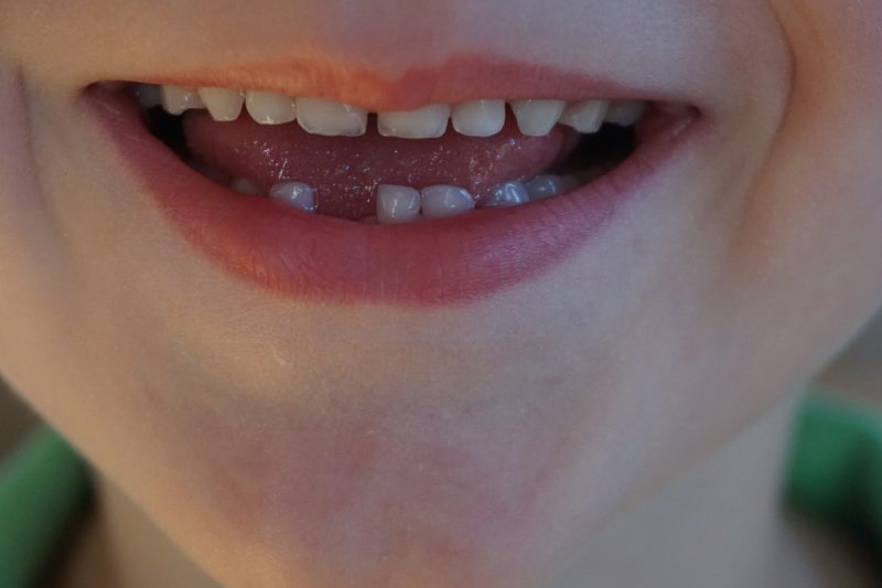 preschooler-losing-tooth